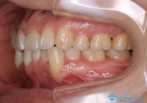 iTero Elementでスキャニング前にPMTCの治療前