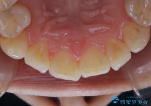 iTero Elementでスキャニング前にPMTCの治療前