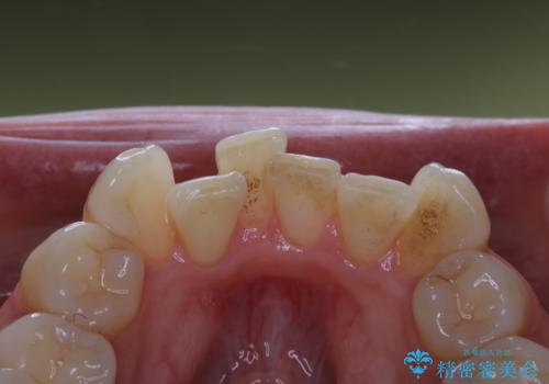 iTero Elementでスキャニング前にPMTC