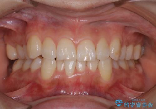 iTero Elementでスキャニング前にPMTCの治療後