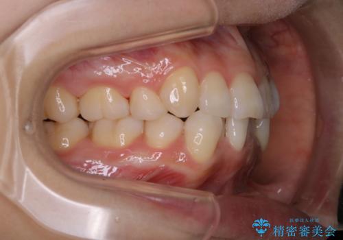 iTero Elementでスキャニング前にPMTCの治療後