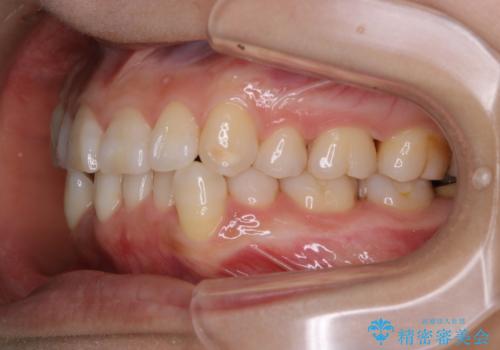 iTero Elementでスキャニング前にPMTCの治療後