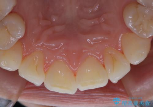 iTero Elementでスキャニング前にPMTCの治療後