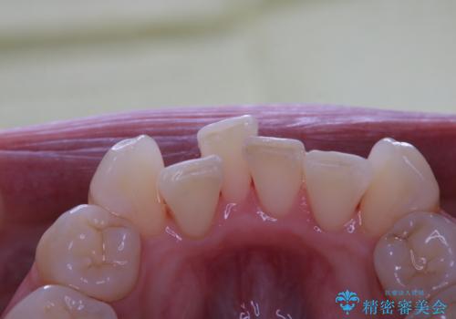 iTero Elementでスキャニング前にPMTCの治療後