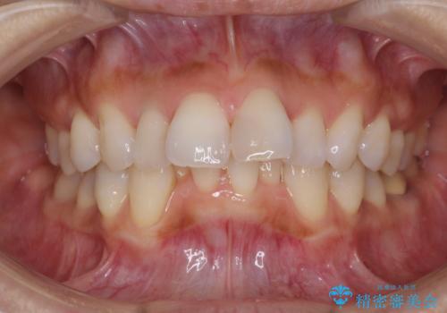 ワイヤーによる抜歯矯正でガタガタと深いかみ合わせの改善の治療前