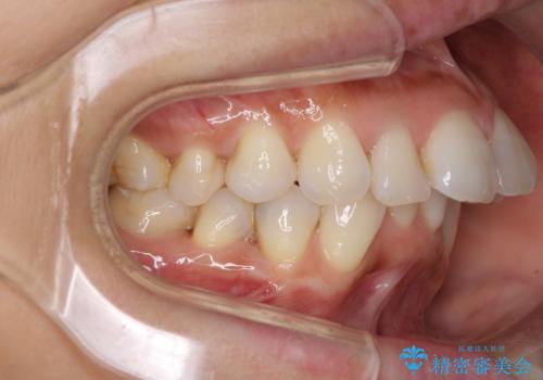 ワイヤーによる抜歯矯正でガタガタと深いかみ合わせの改善の治療前
