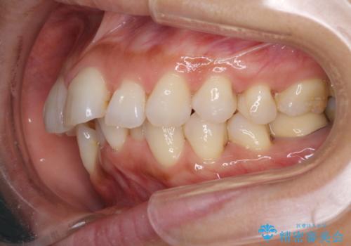 ワイヤーによる抜歯矯正でガタガタと深いかみ合わせの改善の症例 治療前