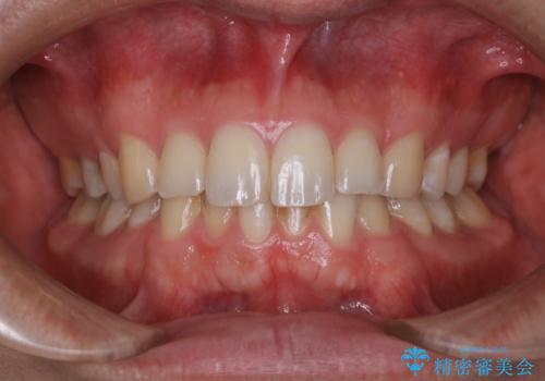 コーヒーの着色落としをPMTCでキレイにの治療前