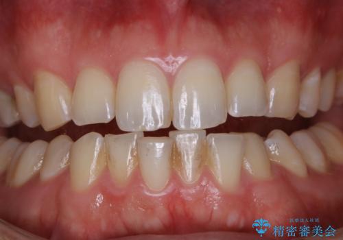 コーヒーの着色落としをPMTCでキレイにの治療前