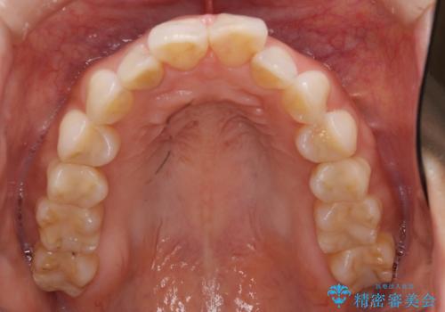ワイヤーによる抜歯矯正でガタガタと深いかみ合わせの改善の治療前