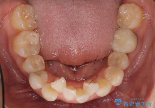 ワイヤーによる抜歯矯正でガタガタと深いかみ合わせの改善の治療前