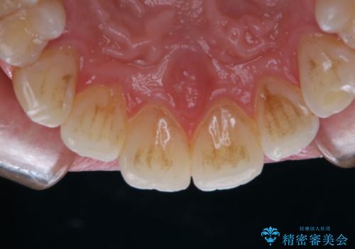 コーヒーの着色落としをPMTCでキレイにの症例 治療前