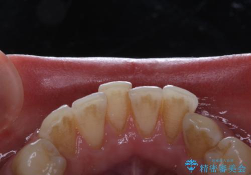 コーヒーの着色落としをPMTCでキレイにの治療前