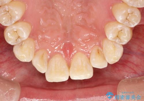 PMTCで歯周病予防の治療後