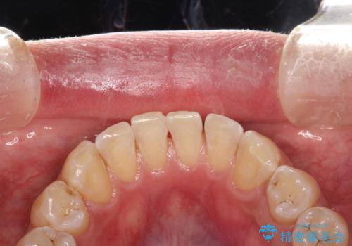 PMTCで歯周病予防の治療後