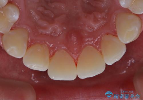 コーヒーの着色落としをPMTCでキレイにの症例 治療後