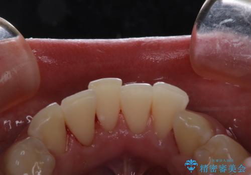 コーヒーの着色落としをPMTCでキレイにの治療後