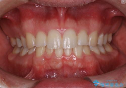 コーヒーの着色落としをPMTCでキレイにの治療後