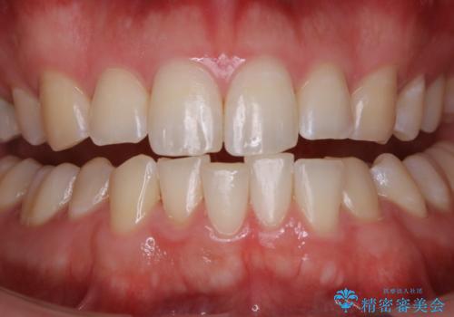 コーヒーの着色落としをPMTCでキレイにの治療後