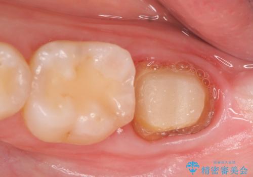 歯冠延長術 他院にてクラウンが入れられないと言われた歯の治療の治療中