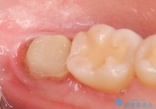 歯冠延長術 他院にてクラウンが入れられないと言われた歯の治療の治療中
