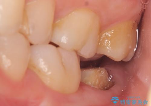 歯冠延長術 他院にてクラウンが入れられないと言われた歯の治療の治療中