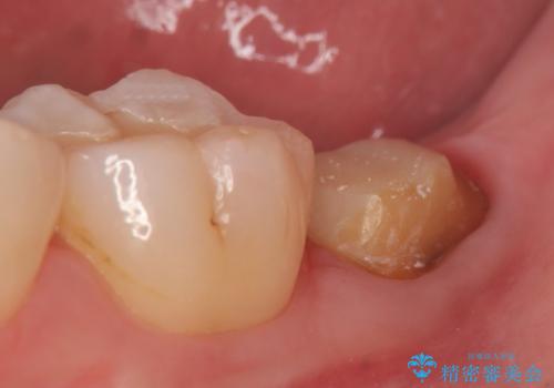 歯冠延長術　他院にてクラウンが入れられないと言われた歯の治療の治療中