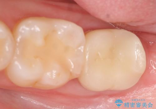 歯冠延長術 他院にてクラウンが入れられないと言われた歯の治療の治療後