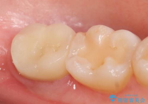 歯冠延長術 他院にてクラウンが入れられないと言われた歯の治療の治療後