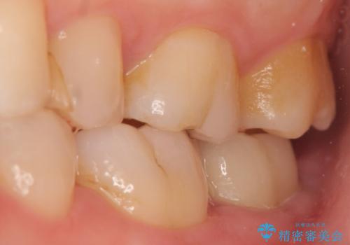 歯冠延長術 他院にてクラウンが入れられないと言われた歯の治療の治療後