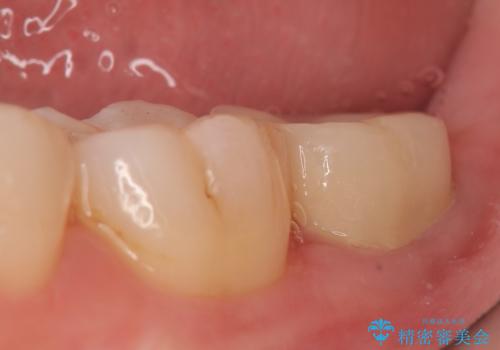 歯冠延長術 他院にてクラウンが入れられないと言われた歯の治療の治療後