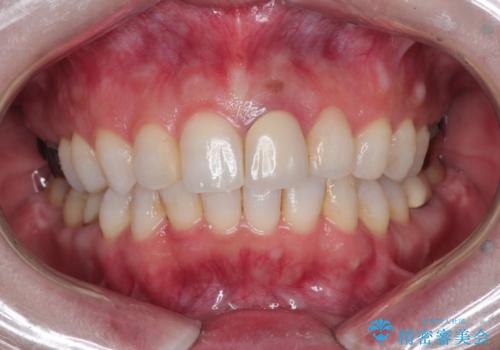 インビザラインによる非抜歯矯正 ガタガタな歯並びを整った歯並びへの症例 治療後