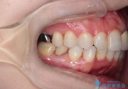 インビザラインによる非抜歯矯正 ガタガタな歯並びを整った歯並びへの治療後