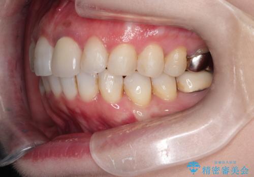 インビザラインによる非抜歯矯正　ガタガタな歯並びを整った歯並びへの治療後