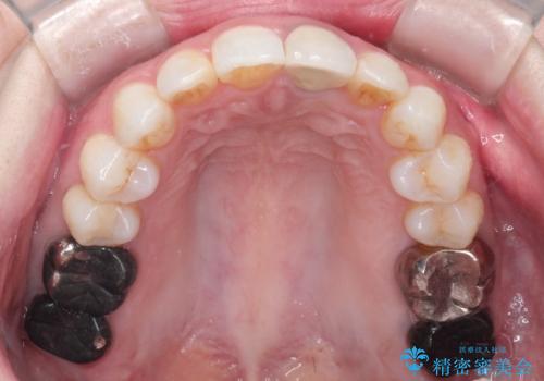 インビザラインによる非抜歯矯正 ガタガタな歯並びを整った歯並びへの治療後