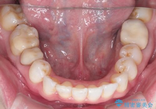 インビザラインによる非抜歯矯正 ガタガタな歯並びを整った歯並びへの治療後