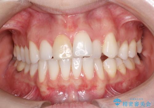 インビザラインによる非抜歯での八重歯の矯正　の症例 治療前