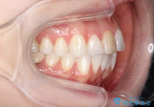 インビザラインによる非抜歯での八重歯の矯正 の治療前