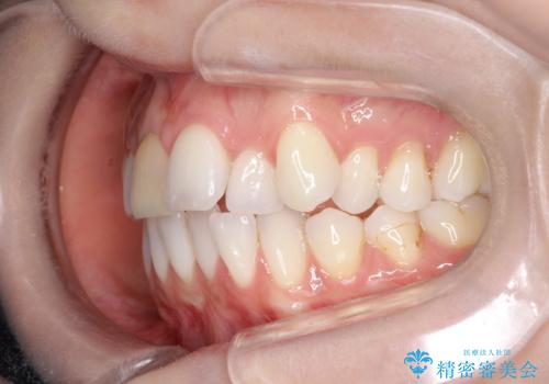 インビザラインによる非抜歯での八重歯の矯正　の治療前