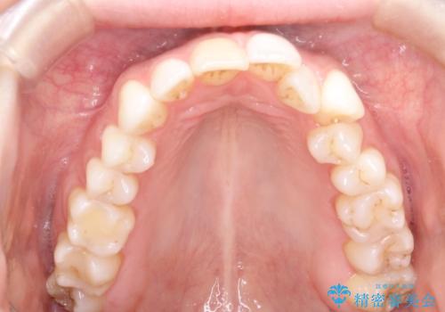 インビザラインによる非抜歯での八重歯の矯正　の治療前