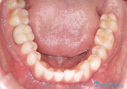 インビザラインによる非抜歯での八重歯の矯正 の治療前