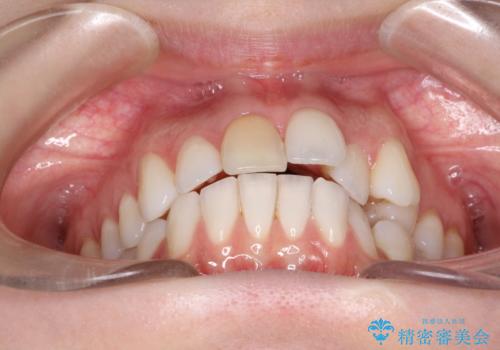 インビザラインによる非抜歯での八重歯の矯正 の治療前
