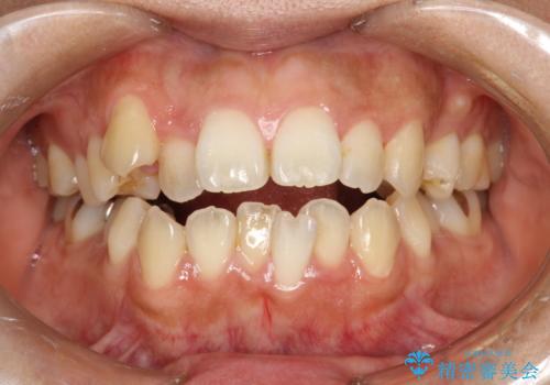 歯科矯正前のPMTCの治療前