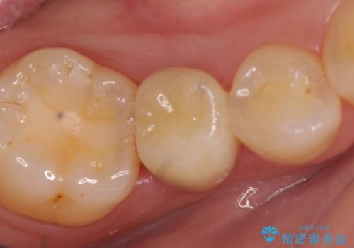 オールセラミッククラウン ズキズキ痛む虫歯の治療の症例 治療後