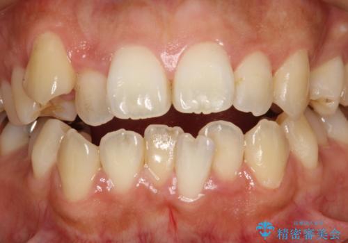 歯科矯正前のPMTCの症例 治療前
