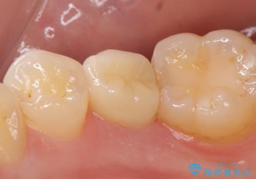 オールセラミッククラウン ズキズキ痛む虫歯の治療の治療後