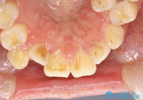 歯科矯正前のPMTCの治療前