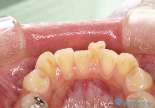 歯科矯正前のPMTCの治療前