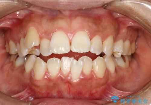歯科矯正前のPMTCの治療後