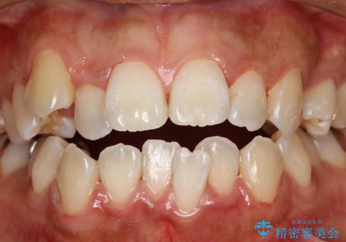歯科矯正前のPMTCの症例 治療後